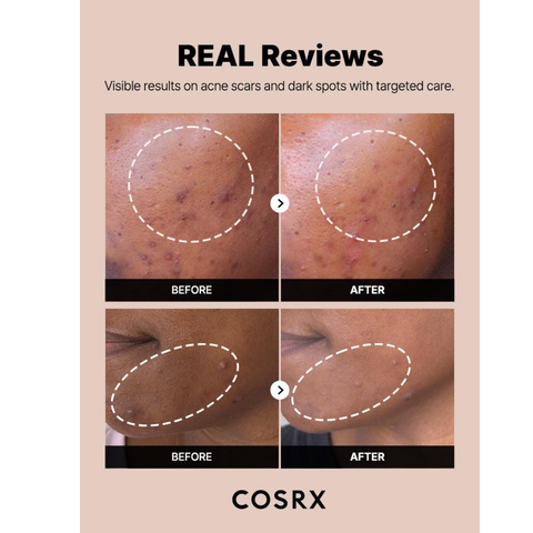 COSRX discoloration serum before after acne scars results